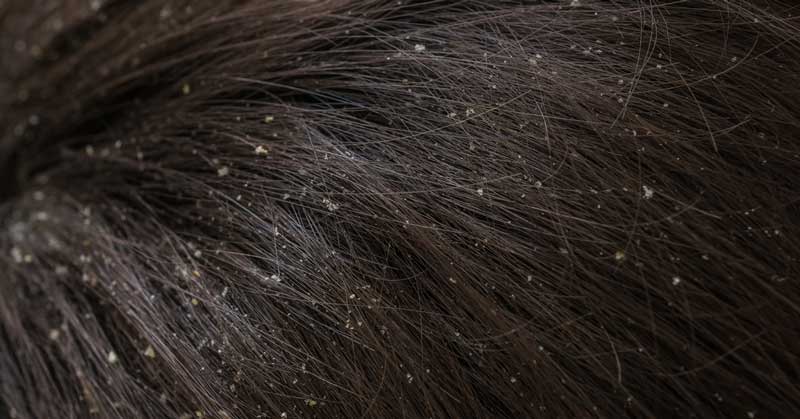  Perut u kosi: kako i zašto nastaje i šta je uklanja