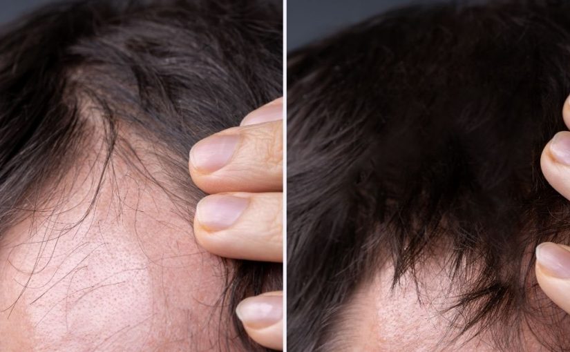  Opadanje kose kod muškaraca : simptomi i rešenja