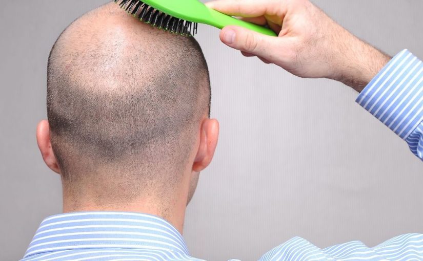  Lek za ćelavost zaista postoji!