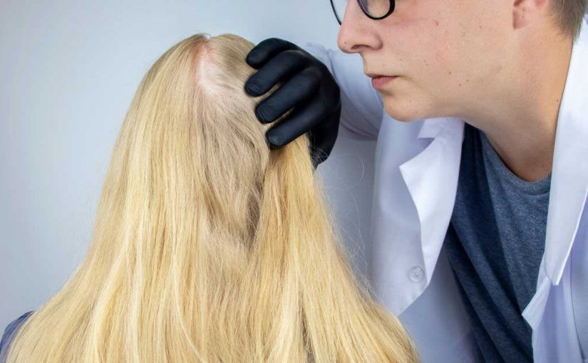  Alopecija: simptomi, uzrok i lečenje!