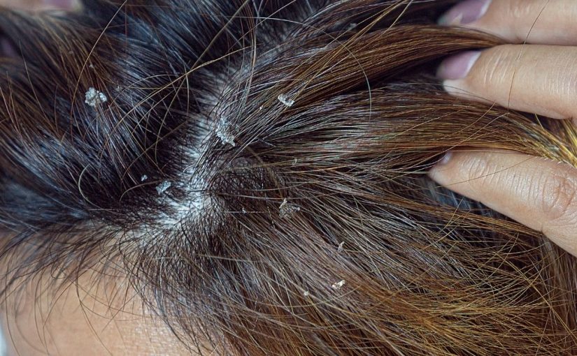  Seboreja na glavi može se rešiti prirodnim putem!