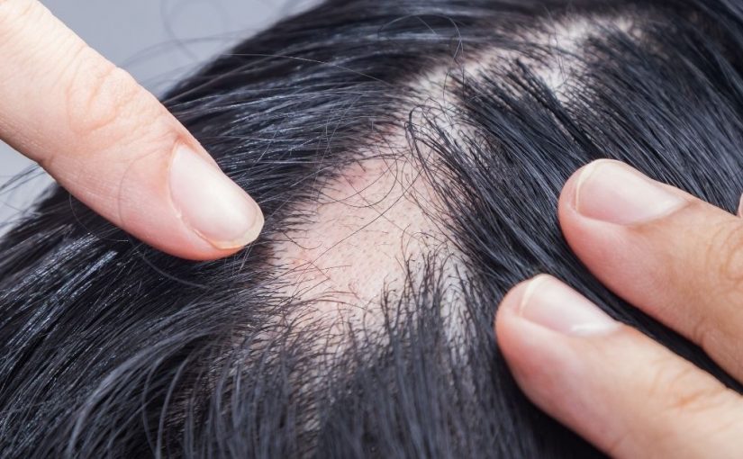 opadanje kose na pečate