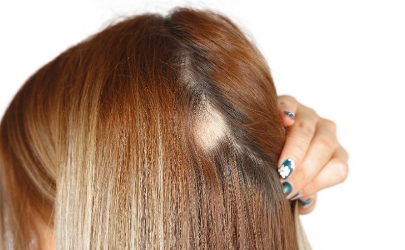 opadanje kose u krugovima