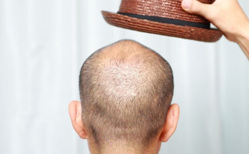  Ćelavost kod muškaraca – zaustavite je!