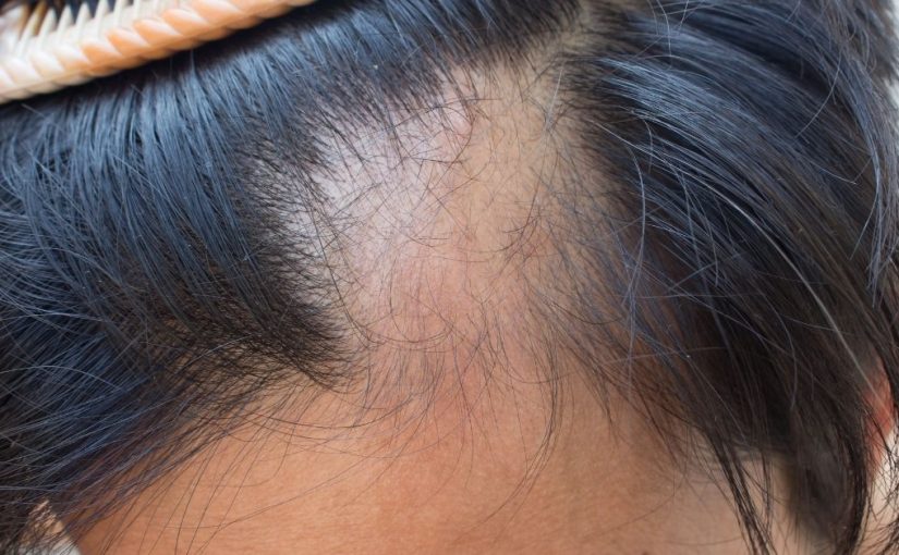  Koliko traje alopecija areata i kako je pobediti?