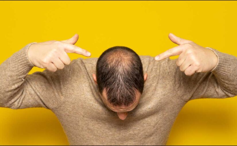  Androgena alopecija: Kako da je prepoznate i pobedite?